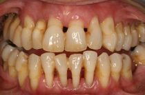 Здоровые зубы – красивая улыбка