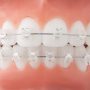 Брекеты Damon Clear2: «невидимое» ортодонтическое лечение