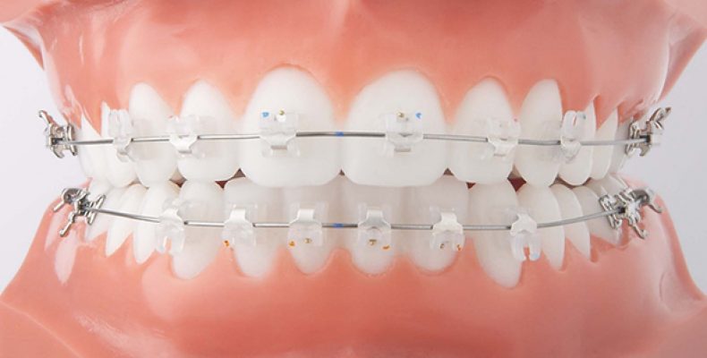 Брекеты Damon Clear2: «невидимое» ортодонтическое лечение