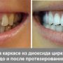 Улучшение зубов и улыбки