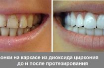 Улучшение зубов и улыбки
