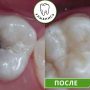Лечение глубокого кариеса зубов в Екатеринбурге