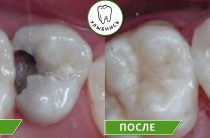 Лечение глубокого кариеса зубов в Екатеринбурге