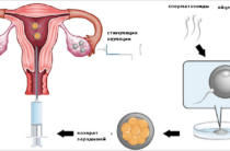 Лечение бесплодия. ЭКО Экстракорпоральное оплодотворение