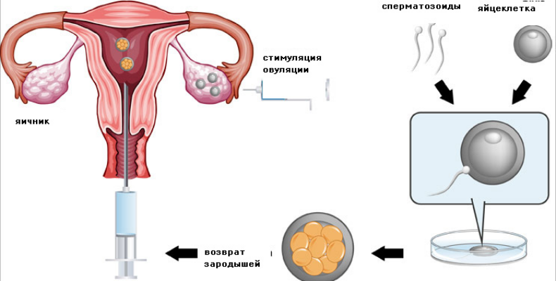 Лечение бесплодия. ЭКО Экстракорпоральное оплодотворение